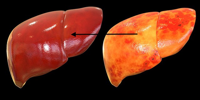 Những thói quen khiến bạn nhanh mắc gan nhiễm mỡ- Ảnh 2.