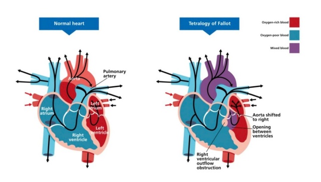 Tứ chứng Fallot: Nguyên nhân, triệu chứng, cách điều trị và phòng bệnh- Ảnh 1.