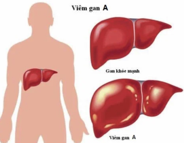 Viêm gan A là gì, nguyên nhân, triệu chứng và cách chữa trị- Ảnh 1.