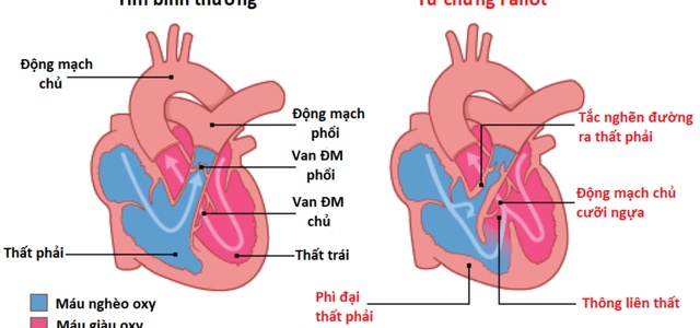 Câu hỏi thường gặp liên quan đến bệnh tứ chứng Fallot- Ảnh 1.