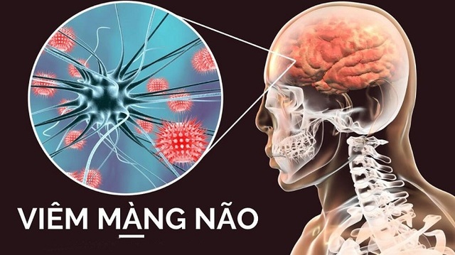 Những câu hỏi liên quan bệnh viêm màng não mủ- Ảnh 1.