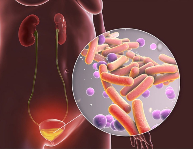 Một số câu hỏi liên quan đến bệnh lao hệ tiết niệu sinh dục- Ảnh 3.