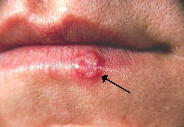 Phân biệt Herpes và nhiệt miệng- Ảnh 1.