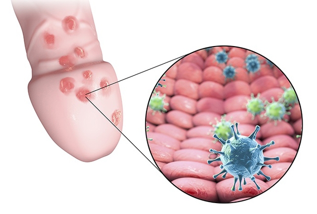 Mụn rộp sinh dục (Herpes): Nguyên nhân, triệu chứng và cách điều trị, phòng ngừa- Ảnh 2.