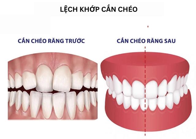 Lệch khớp cắn: Nguyên nhân, biểu hiện, cách điều trị và phòng bệnh- Ảnh 2.