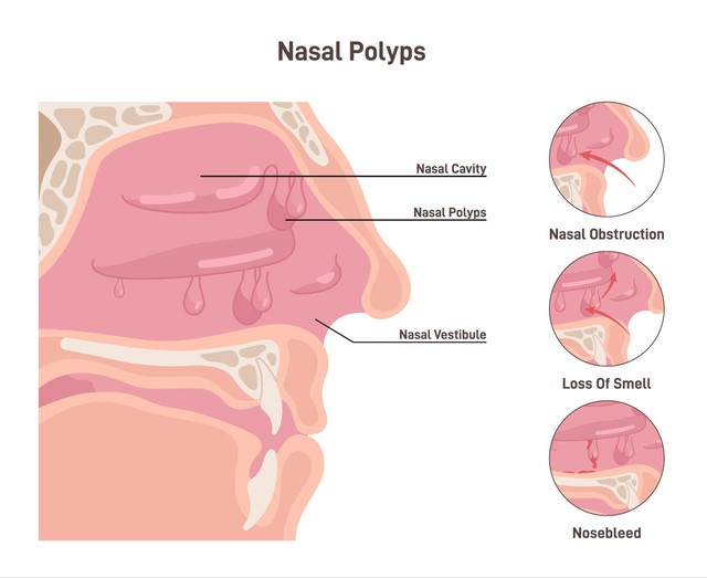 Polyp mũi tái phát liên tục, học cách kiểm soát bệnh hiệu quả- Ảnh 2.