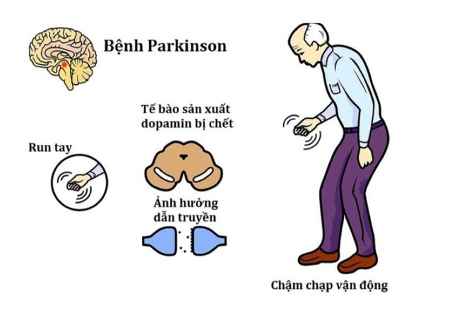 Uống cà phê có tốt cho người mắc bệnh Parkinson không?- Ảnh 1.