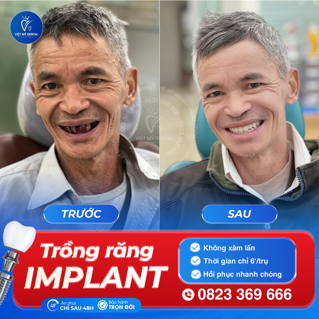 Việt Mỹ - Dịch vụ trồng răng công nghệ cao Implant, uy tín trong ngành- Ảnh 1.