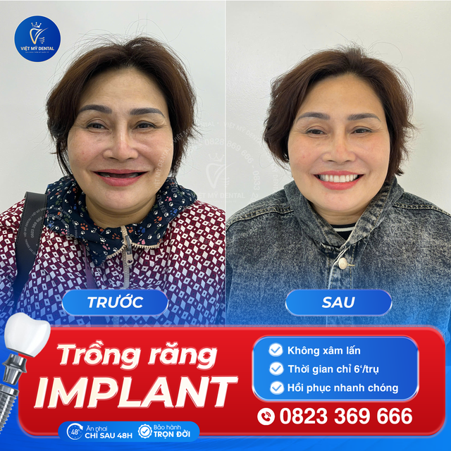 Việt Mỹ - Dịch vụ trồng răng công nghệ cao Implant, uy tín trong ngành- Ảnh 2.