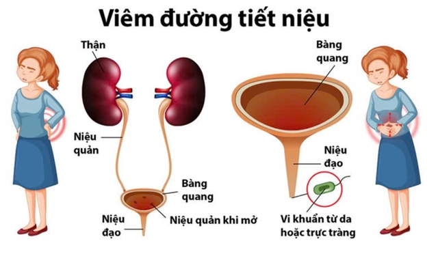 Bệnh viêm đường tiết niệu: Nguyên nhân, triệu chứng, phòng bệnh và cách điều trị- Ảnh 2.