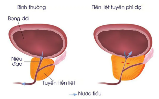 3 vấn đề ở tuyến tiền liệt làm giảm 'khả năng yêu' của nam giới- Ảnh 1.