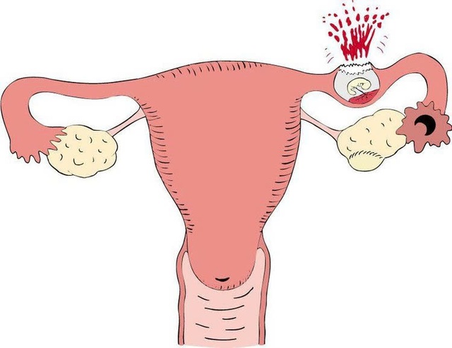 Bệnh vỡ tử cung: Nguyên nhân, triệu chứng, phòng bệnh và cách điều trị- Ảnh 1.