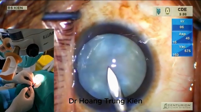 Đột phá mới trong phẫu thuật đục thủy tinh thể chín trắng căng phồng- Ảnh 3. Đột phá mới trong phẫu thuật đục thủy tinh thể chín trắng căng phồng- Ảnh 3.