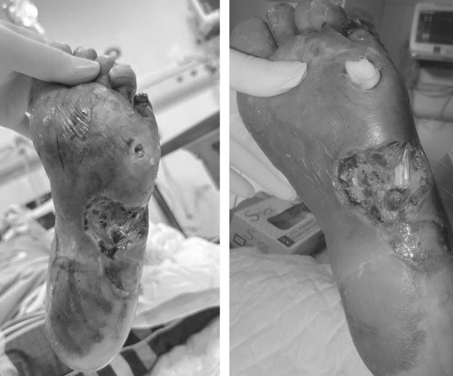 Người đàn ông suýt phải cắt cụt chân vì đái tháo đường- Ảnh 1. Người đàn ông suýt phải cắt cụt chân vì đái tháo đường- Ảnh 1.