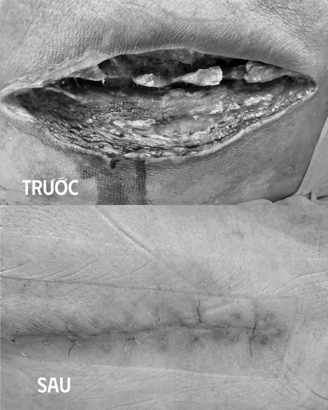 Cứu sống bệnh nhân nhiễm trùng phức tạp sau mổ cột sống- Ảnh 2. Cứu sống bệnh nhân nhiễm trùng phức tạp sau mổ cột sống- Ảnh 2.