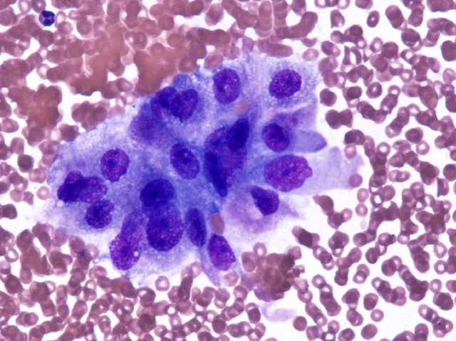 Ung thư dịch màng: bước tiến mới trong chẩn đoán ung thư không cần sinh thiết- Ảnh 1.