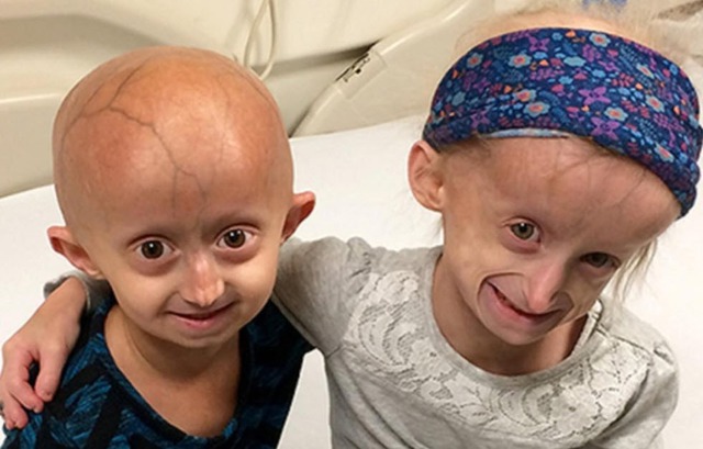 Trẻ nhỏ già đi như người già do bí ẩn gen lỗi trong hội chứng Progeria- Ảnh 1.