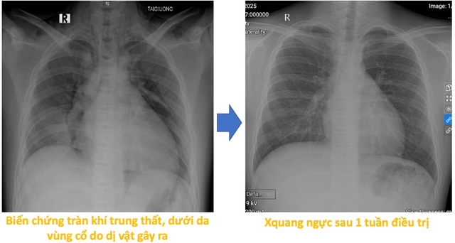 Vừa xem tivi vừa chơi, bé 13 tuổi nuốt đinh ghim vào đường thở- Ảnh 3. Vừa xem tivi vừa chơi, bé 13 tuổi nuốt đinh ghim vào đường thở- Ảnh 3.