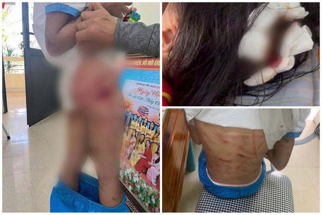 Bạo hành trẻ em: Vết thương từ gia đình và rào cản pháp lý- Ảnh 1. Bạo hành trẻ em: Vết thương từ gia đình và rào cản pháp lý- Ảnh 1.