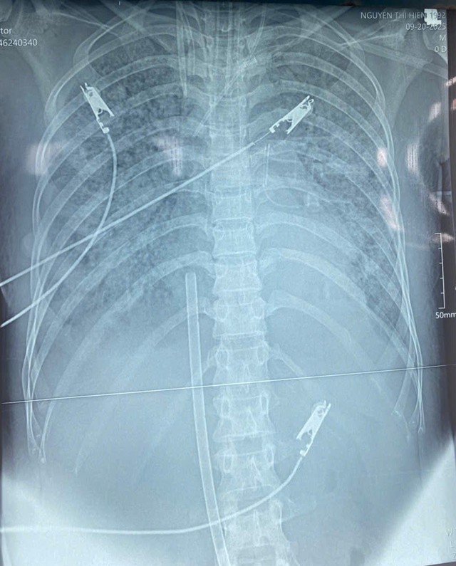 Bệnh viện Hữu nghị Đa khoa Nghệ An cứu sống bệnh nhân nguy kịch nhờ kỹ thuật Hybrid ECMO- Ảnh 2. Bệnh viện Hữu nghị Đa khoa Nghệ An cứu sống bệnh nhân nguy kịch nhờ kỹ thuật Hybrid ECMO- Ảnh 2.