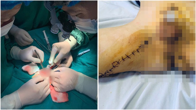 Nối dương vật thành công cho bệnh nhi ở Hải Phòng- Ảnh 1. Nối dương vật thành công cho bệnh nhi ở Hải Phòng- Ảnh 1.