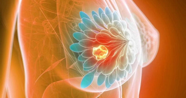 Phát hiện sớm ung thư vú nhờ ứng dụng AI trong chụp nhũ ảnh tầm soát- Ảnh 3. Phát hiện sớm ung thư vú nhờ ứng dụng AI trong chụp nhũ ảnh tầm soát- Ảnh 3.