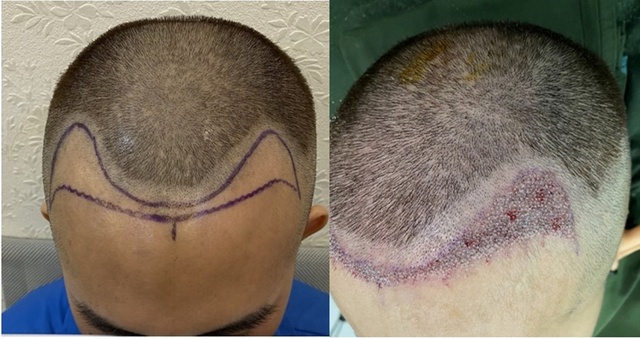Rụng tóc do androgen có thể dẫn đến trầm cảm, lo âu- Ảnh 2.