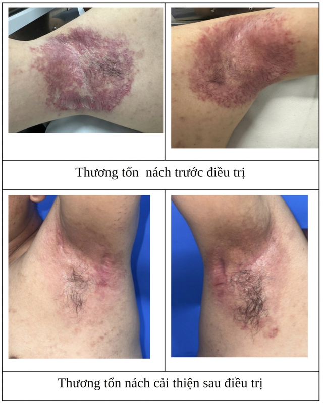 Thoát khỏi 6 năm đau đớn vì bệnh da hiếm gặp nhờ phương pháp điều trị mới- Ảnh 1. Thoát khỏi 6 năm đau đớn vì bệnh da hiếm gặp nhờ phương pháp điều trị mới- Ảnh 1.