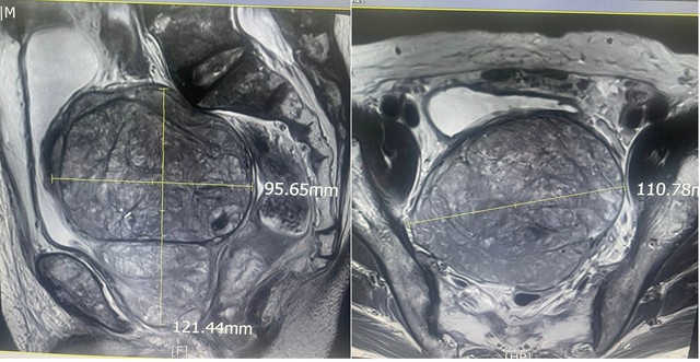 Bệnh viện Hữu Nghị cắt bỏ u tuyến tiền liệt 'khủng' 600 gram cho cụ ông 83 tuổi- Ảnh 2. Bệnh viện Hữu Nghị cắt bỏ u tuyến tiền liệt 'khủng' 600 gram cho cụ ông 83 tuổi- Ảnh 2.
