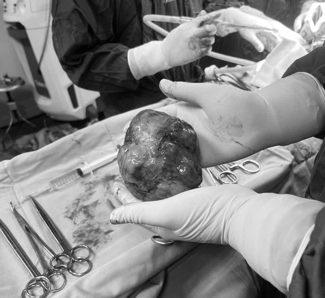 Bệnh viện Hữu Nghị cắt bỏ u tuyến tiền liệt 'khủng' 600 gram cho cụ ông 83 tuổi- Ảnh 3. Bệnh viện Hữu Nghị cắt bỏ u tuyến tiền liệt 'khủng' 600 gram cho cụ ông 83 tuổi- Ảnh 3.