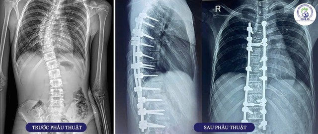 Bệnh viện Chấn thương Chỉnh hình Nghệ An: Địa chỉ tin cậy trong điều trị vẹo cột sống- Ảnh 1. Bệnh viện Chấn thương Chỉnh hình Nghệ An: Địa chỉ tin cậy trong điều trị vẹo cột sống- Ảnh 1.