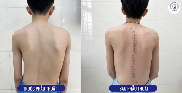 Bệnh viện Chấn thương Chỉnh hình Nghệ An: Địa chỉ tin cậy trong điều trị vẹo cột sống- Ảnh 3. Bệnh viện Chấn thương Chỉnh hình Nghệ An: Địa chỉ tin cậy trong điều trị vẹo cột sống- Ảnh 3.