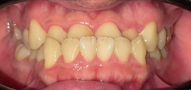 Niềng răng không chỉ vì thẩm mỹ mà còn vì sức khỏe toàn diện- Ảnh 1.