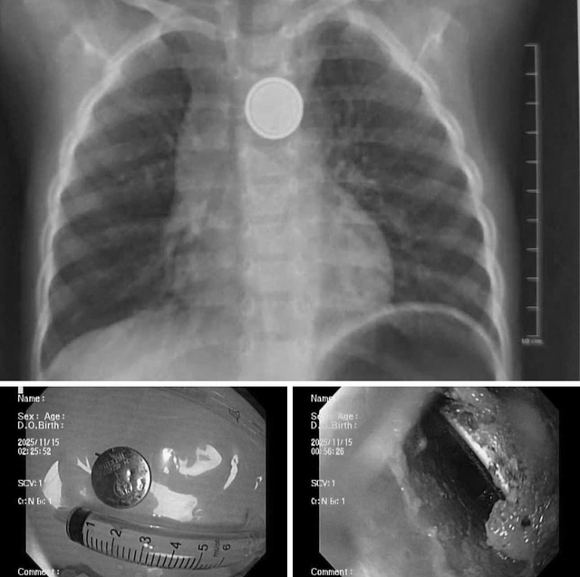Bé trai ở Hải Phòng bị loét thực quản nặng vì nuốt pin cúc áo- Ảnh 1.