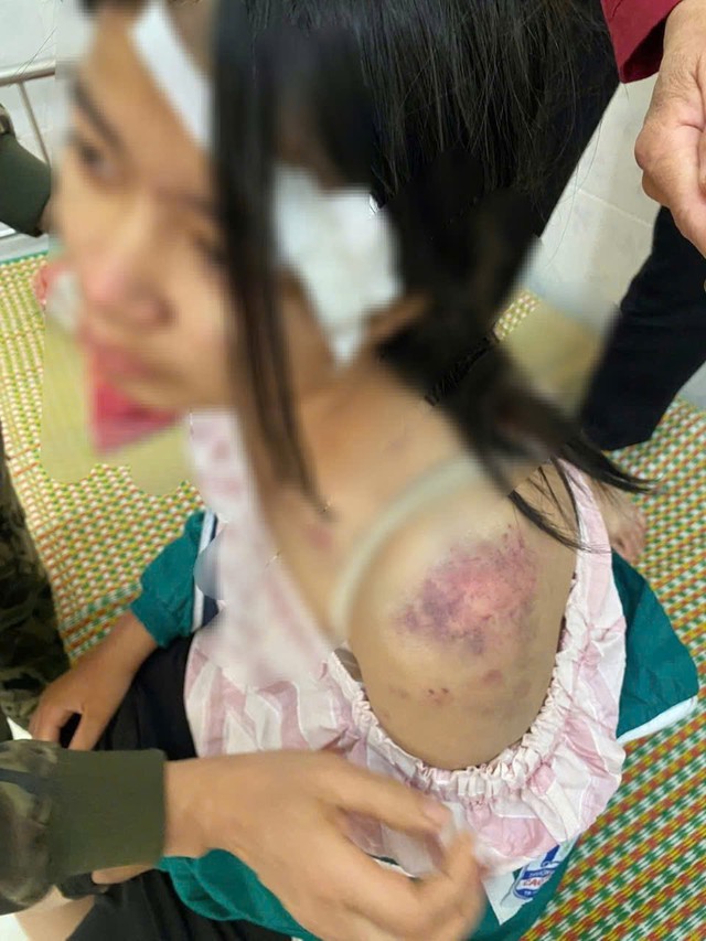 Những vết thương chi chít trên cơ thể của cô bé bị bạo hành- Ảnh 1. Những vết thương chi chít trên cơ thể của cô bé bị bạo hành- Ảnh 1.