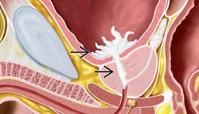 Không thấy tinh dịch sau quan hệ cảnh báo xuất tinh ngược- Ảnh 1.