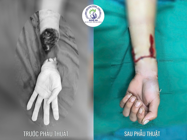 Nối thành công bàn tay đứt lìa qua mốc 'giờ vàng' – chạy đua cùng thời gian- Ảnh 1. Nối thành công bàn tay đứt lìa qua mốc 'giờ vàng' – chạy đua cùng thời gian- Ảnh 1.