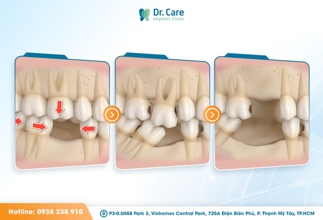 Có nên trồng răng số 6 (răng cấm) khi mất răng, chi phí có đáng với chất lượng?- Ảnh 1.