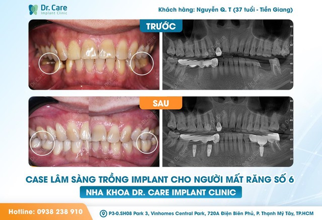 Có nên trồng răng số 6 (răng cấm) khi mất răng, chi phí có đáng với chất lượng?- Ảnh 3.