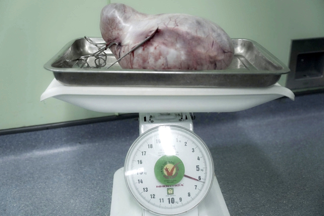 Phẫu thuật khối u nang buồng trứng nặng 6kg cho người phụ nữ 56 tuổi- Ảnh 3. Phẫu thuật khối u nang buồng trứng nặng 6kg cho người phụ nữ 56 tuổi- Ảnh 3.