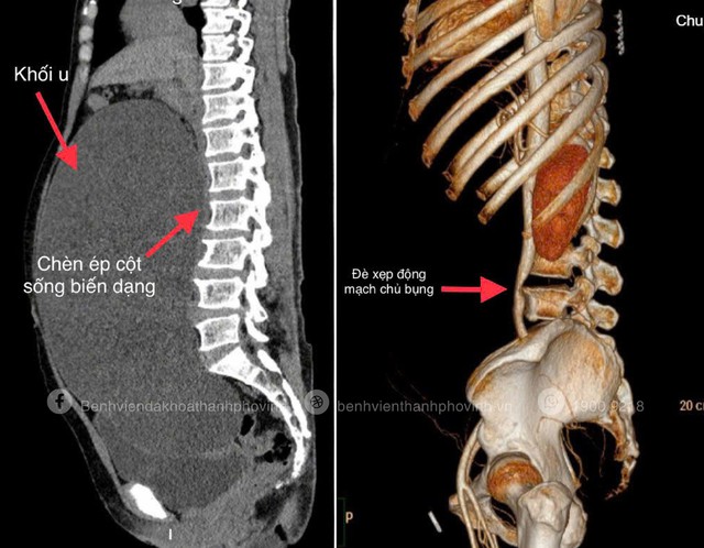 Hình ảnh khối u nang buồng trứng khổng lồ chiếm trọn ổ bụng, chèn ép gây xẹp động mạch chủ bụng, các cơ quan bị đẩy lệch vị trí, niệu quản bị ép gây giãn đài bể thận hai bên. Hình ảnh khối u nang buồng trứng khổng lồ chiếm trọn ổ bụng, chèn ép gây xẹp động mạch chủ bụng, các cơ quan bị đẩy lệch vị trí, niệu quản bị ép gây giãn đài bể thận hai bên.