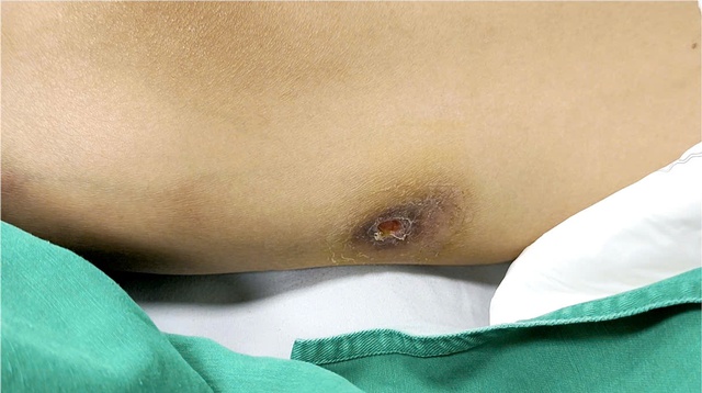 Nam thanh niên mắc Whitmore, áp xe đa tạng- Ảnh 2.