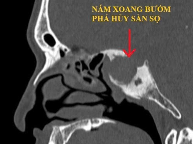 Ca bệnh hiếm: Nấm xoang bướm ‘giả u não’ khiến người đàn ông mất thị lực- Ảnh 1.