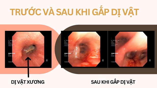 Hai bệnh nhân thoát nguy kịch nhờ gắp dị vật đường thở kịp thời- Ảnh 3.