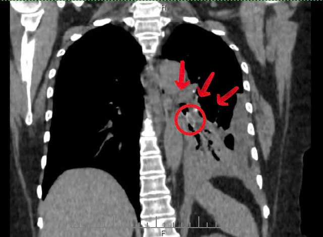 Hai bệnh nhân thoát nguy kịch nhờ gắp dị vật đường thở kịp thời- Ảnh 2.
