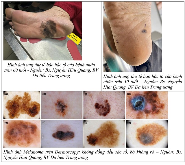Dấu hiệu ung thư tế bào hắc tố ở da- Ảnh 1.
