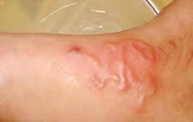 Nhiều trường hợp ở Khánh Hòa bị sán chó, người dân chủ động phòng bệnh- Ảnh 2. Nhiều trường hợp ở Khánh Hòa bị sán chó, người dân chủ động phòng bệnh- Ảnh 2.