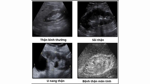Suy thận siêu âm có ra không? Tìm hiểu ngay để biết!- Ảnh 2. Suy thận siêu âm có ra không? Tìm hiểu ngay để biết!- Ảnh 2.