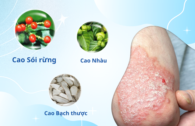 Kiểm soát vảy nến thế nào để hạn chế tái phát vào mùa đông khô lạnh?- Ảnh 2. Kiểm soát vảy nến thế nào để hạn chế tái phát vào mùa đông khô lạnh?- Ảnh 2.