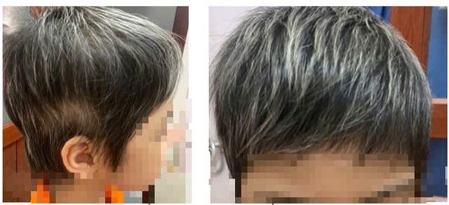 Bé gái 7 tuổi rụng hết tóc bất ngờ mọc kín đầu sau một năm- Ảnh 2. Bé gái 7 tuổi rụng hết tóc bất ngờ mọc kín đầu sau một năm- Ảnh 2.